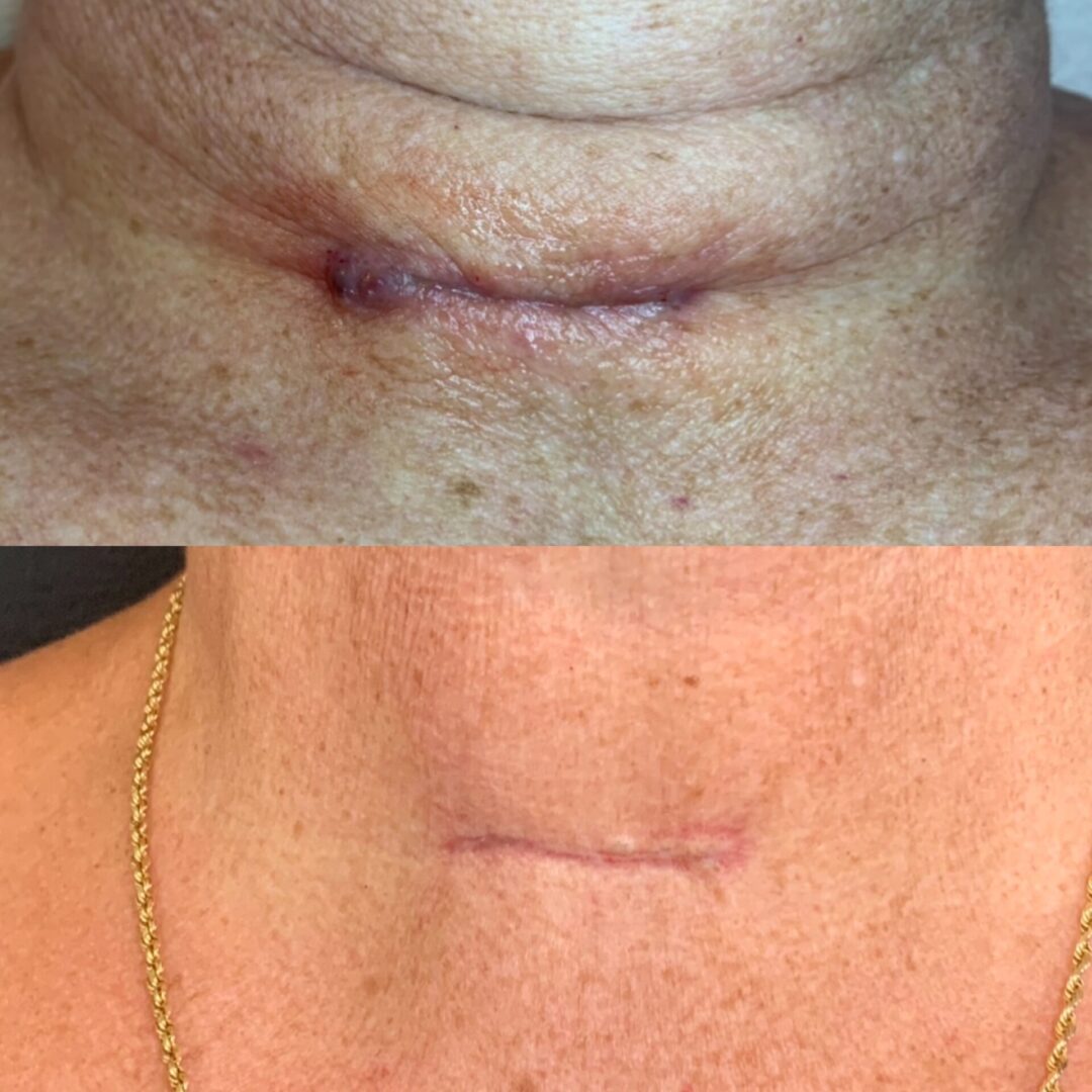 A before and after photo of the neck area.