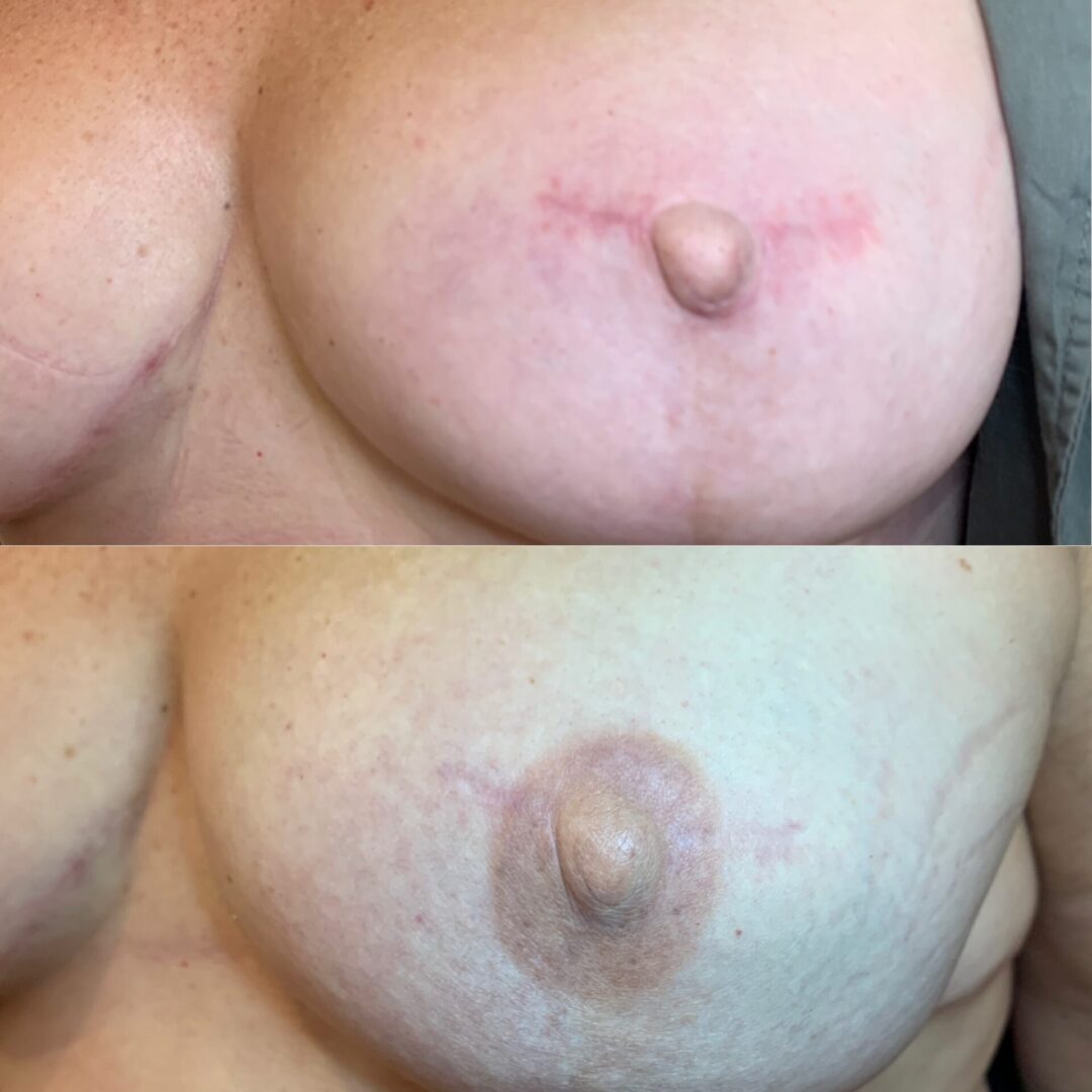 A before and after photo of the breast implant.